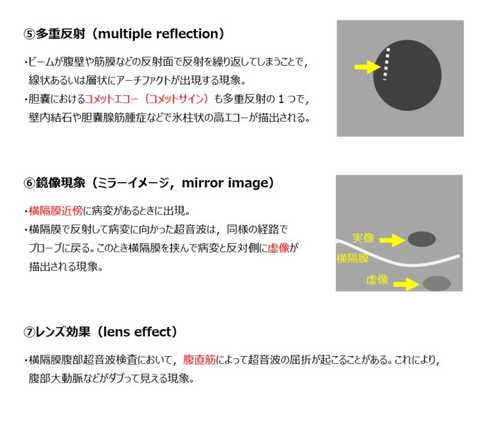 超音波アーチファクト2