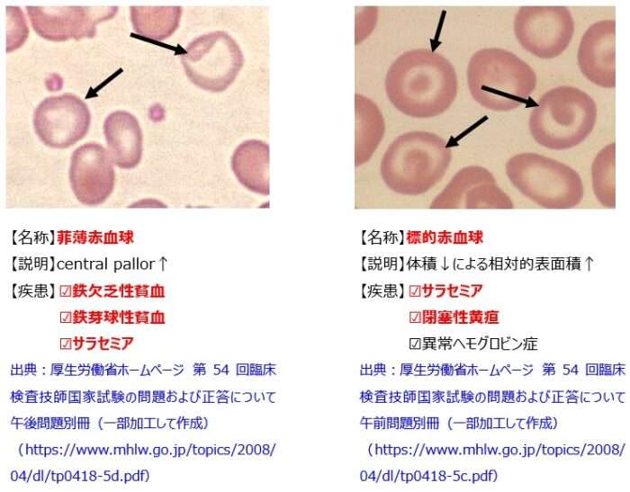 変形赤血球1
